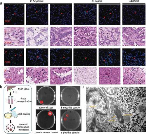 Figure 2. Validation experiments show the presence of bacteria in the tissues. (a) Results of FISH fluorescence staining and HE section staining of ICC tissues. The green signal indicates the synthetic FISH probe and the red signal indicates the positive probe signal (EUB338). The red arrow indicates the spot of the signal in the slices. T: tumor tissue slice; P: paracancerous tissue slice. (b) Fresh ICC patient tissue (tissue obtained shortly after surgery) was used to homogenize and culture live bacteria. The flowchart on the left shows the basic process of culturing bacteria from fresh tumor tissues. The diagram on the right shows the microbial colonies cultured from fresh tissues. Pure culture medium was used as a negative control, and wipes from the sink or door handle environment were used as a positive control. ‘B’ denotes that we used Brain heart infusion (BHI), which is a growth medium for growing microorganisms. (c) TEM experiments show the existence of bacteria in ICC tumor tissues (the locations marked with yellow arrows denote bacteria).