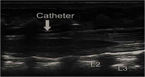 Figure 2. Introduce epidural catheter ultrasound guided