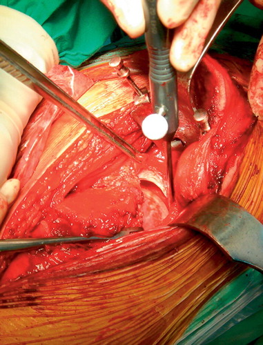 Figure 3. By manual traction of the involved leg, the acetabulum can be visualized. A probe is used to track and register the articular surface.