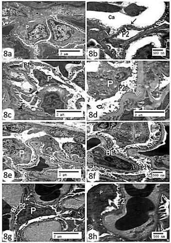 Figure 8. Electron micrograph of the renal glomerulus (a,b): control group showing a podocyte (P) with primary foot process (P1) and regularly spaced normal-looking secondary foot processes (P2) and thin basal lamina (BL), with wide longitudinal glomerular capillary (Ca) (Scale bar of a = 500 nm and Scale bar of b = 2 µm). (c,d): CCl4 group showing marked thickening of basal lamina (BL), fusion of secondary pedicles foot processes (P2), degenerated podocytes with pyknotic nucleus (P) and fusion of primary foot process (P1) (Scale bar = 2 µm). (e,f) CCl4 + rats’ BM-MScs showing almost normal thin basal lamina (BL), euchromatic nucleus (N), podocyte (P), and regularly spaced normal-looking secondary foot processes (P2) (Scale bar of e = 500 nm and Scale bar of f = 2 µm). (g,h) CCl4 + mice BM-MSCs showing marked recovery of the podocyte (P), euchromatic nucleus (N), with secondary foot processes (P2) and basal lamina (BL) (Scale bar of g = 500 nm and Scale bar of h = 2 µm).