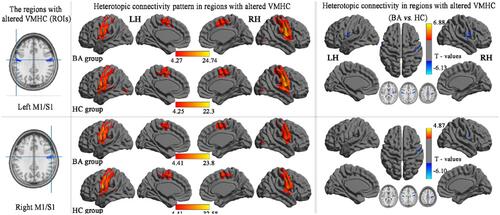 Figure 5 Group comparisons seed-based FC of the altered VMHC between the BA and HC seed regions in bilateral M1/S1. (P < 0.01, GRF-corrected at a cluster level of P < 0.05).