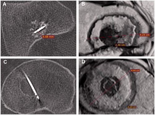 Figure 2. (A, B) intraoperative CT and postoperative gadolinium-enhanced MR of a tumor ablated close to the cortical wall in a femur metaphysis. (C, D) intraoperative CT and postoperative gadolinium-enhanced MR images of a centrally located tumor ablated in a femur metaphysis.