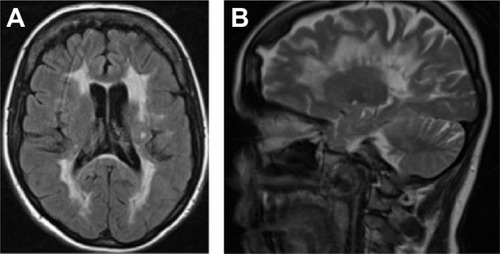 Figure 1 Brain MRI of Case no 1.