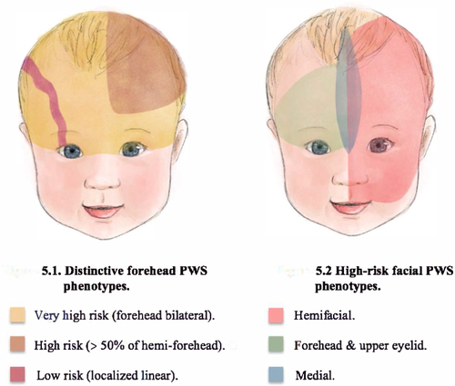 Figure 1 Risk stratification for the development of Sturge Weber Syndrome (SWS) based on distinct facial port-wine birthmark (PWB) phenotypes.