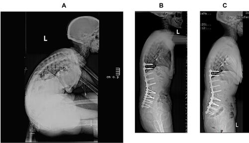 Figure 4 A 46-year-old female patient. (A) It shows the disease is located at the apex of L2–L3, and the patient is allocated to the lumbar kyphosis group. (B) The SPO osteotomy is performed at L1–L2, L4–L5, and L5–S1. The single segmental PSO osteotomy is performed at L3. The GK and SVA change to 59° and 56.36 mm from 103° and 261.49 mm, respectively. The LL is corrected to postoperative −44° from preoperative 41°. (C) During the follow-up, no significant correction loss is observed in the final year. The LL, GK, and SVA are −45°, 62°, and 48.82 mm, respectively.