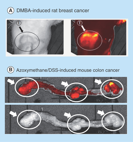 Figure 4.  In vivo fluorescence imaging of carcinogen-induced tumors with N-(2-hydroxypropyl)methacrylamide copolymer-conjugated zinc protoporphyri.Fluorescent views of DMBA-induced rat breast cancers (A) and azoxymethane/dextran sulfate sodium-induced colon cancers (B) were obtained at 48 h after intravenous drug injection (15 mg/kg zinc protoporphyrin). Arrows point to fluorescent tumor nodules (see text for details).DMBA: 7,12-dimethylbenz[a]anthracene; DSS: Dextran sulfate sodium; ZnPP: Zinc protoporphyrin; PZP: N-(2-hydroxypropyl)methacrylamide copolymer-conjugated zinc protoporphyrin.