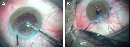 Figure 1 Clear corneal phacoemulsification (A) and Vicryl 6/0 traction suture (B).