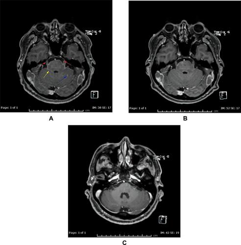 Figure 2 Axial post contrast fat saturated images of the brain: before (A) and 14 days (B), and three months (C) post-osimertinib. (A) Before treatment showing multiple small enhancing foci in the left cerebellar hemisphere (blue arrow), abnormal enhancement involving the perimesencephalic cistern (yellow arrow) and abnormal enhancement of the trigeminal nerve bilaterally (red arrows). (B) After treatment showing almost complete clearance of the abovementioned nodules in left cerebellar hemisphere, the abnormal enhancement in the perimesencephalic cistern and the trigeminal nerves. (C) After three months treatment showing persistent improvement with no detected nodules or meningeal enhancement.
