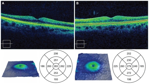 Figure 5 Spectral OCT images of the right a) and left b) eyes 28 months postingestion showing atrophy of the neuroretina.