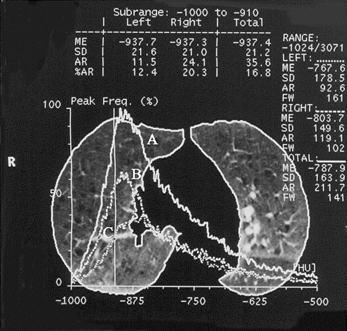 Figure 2 HRCT scan at the carina level, at 10% of vital capacity. Lung parenchyma contours are outlined; the 3 HU frequency functions represent distribution of lung density for both lungs (A), right (B), and left ones (C), respectively, and are used to compute Mean CT exp (HU) (ME in the picture = − 787.9 HU for both lungs); the vertical line represents − 910 HU threshold, and it is used to compute RAE910 (% lung area) (corresponding to % AR in the picture = 16,8 for both lungs). Other figures in the picture are not used in the analyses.