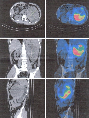 Figure 3 123I MIGB scintigraphy indicating exclusive uptake of 123I-MIBG at the tumor mass.