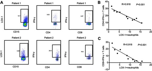 Figure 3 LOX-1+ PMN is negatively correlation with effector immune cells in GBM patient PB. (A) Typical example of the analysis of the proportion of LOX-1+ PMN, IFN-γ+CD4+ T cells and IFN-γ+CD8+ T cells in two patients with GBM. (B, C) Quantification showing the associations between LOX-1+ PMN and IFN-γ+CD4+ T cells (B) and IFN-γ+CD8+ T cells in 10 patients with GBM (C).Abbreviations: LOX-1, lectin-type oxidized LDL receptor 1; PMN, polymorphonuclear neutrophil; GBM, glioblastoma multiforme; PB, peripheral blood.