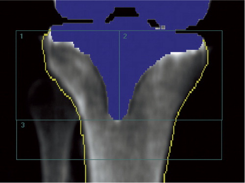 Figure 4. AP densitometry analysis of a right tibia (implant) with software-automated metal removal (blue) and bone-edge detection (yellow line), and manual positioning of the 3-ROI BMD cruxiate stem template. The bone of the fibula was excluded from the analysis.