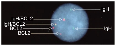 Figure 4 Analysis using fluorescence in situ hybridization demonstrated fusion yellow signals consisting of green (IgH gene) and red (BCL2 gene) signals, which directly suggested a t(14,18)(q32,q21) translocation, in 49/50 cells.