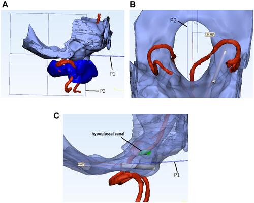 Figure 4 (A) The 3D model of skull base, occipital condyle, AOCS, vertebral artery and atlas in 3-matic 19.0, (B) the measurement of divergence angle between AOCS and vertical plane (P2) of foramen magnum, (C) the measurement of inclination angle between AOCS and horizontal plane (P1) of foramen magnum, and there was no injury to hypoglossal canal or vertebral artery.