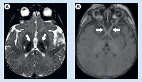 Figure 6. MRI in globoid cell leukodystrophy (Krabbe disease).(A) Signal changes in the bilateral thalami, (B) optic nerve enlargement.Reproduced with permission from Citation[76].