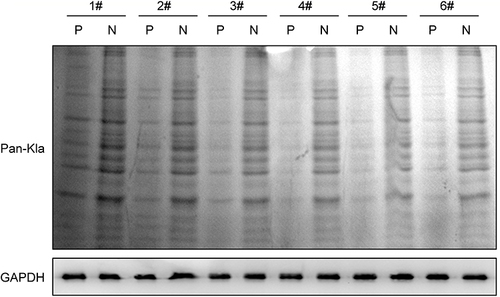 Figure 2 Lactylation level was up-regulated in the psoriasis patients. The global Lactylation levels in the skin samples were detecting by Western blot assay using Anti-L-Lactyl.