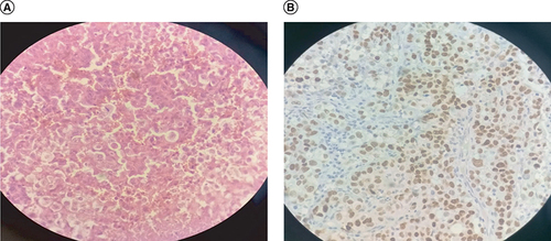 Figure 2. Histological examination of lymphadenopathy.(A) Hematoxylin and eosin staining showing tumoral proliferation. (B) Immunohistochemistry showing positive staining for TTF-1.