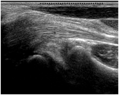 Figure 2. A longitudinal section of an ultra-sound clearly demonstrating a reversed palmaris longus muscle belly (*) lying onto of the flexor retinaculum. The deep flexor tendons (‡) and radial carpal joint lie inferiorly.