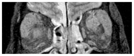 Figure 1 T2 MRI images of a patient with swollen lacrimal glands. The MRI images were obtained at the first visit to our hospital. The MRI findings indicate extreme swelling of both lacrimal glands.