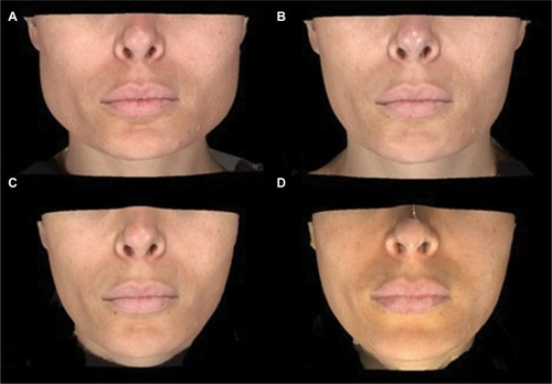 Figure 6 Patient at baseline (A), week 6 (B), week 16 (C), and week 20 (D) after an MIT of incobotulinumtoxinA in the masseters for the treatment of masseter hypertrophy.