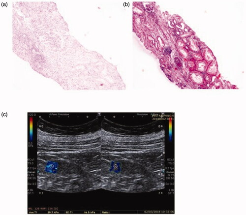 Figure 2. Patient 2: light microscopic images of renal tissue that stage T1 (moderate IFTA)-stage F2 (severe IF) and their SWE image. (a) H&E ×200. (b) Masson’s trichrome ×200. (c) YM = 29.7 kPa (compatible with the stage F2 (severe IF)).