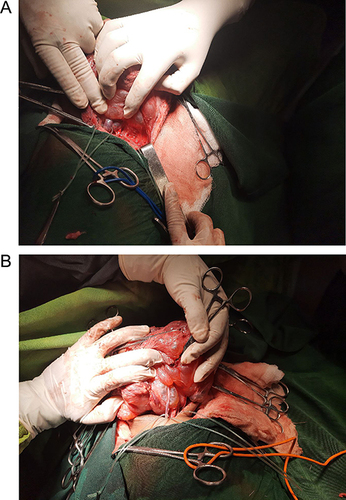 Figure 3 (A) The internal jugular vein, common carotid artery and vagus nerve are exposed and controlled with loop; (B) shows on further mobilizations of the mass the internal jugular vein is seen passing through the mid portion of the mass.