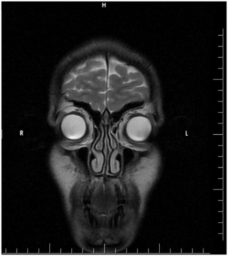 Figure 3. The MR image of the patient taken before the application. MR imaging shows that there are no pathology in bilateral frontal, ethmoid and maxillary sinuses.