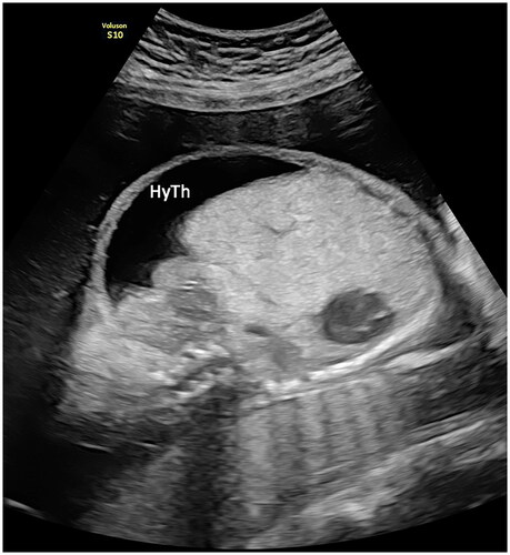 Figure 2. Fetal ascites at 28 gestational weeks. Hydrothorax (HyTh) and subcutaneous edema. Polyhydramnios, AFI 36 cm.