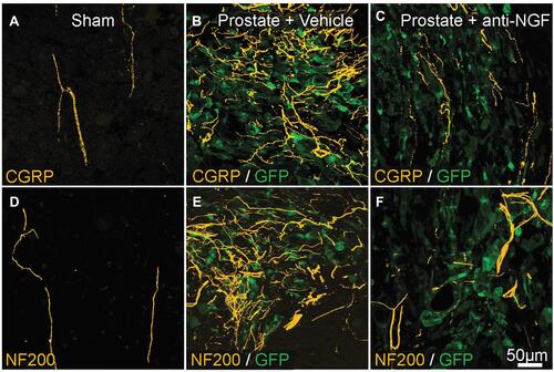 Figure 4 Preventative administration of anti-NGF antibody reduces metastatic prostate cancer-induced CGRP+ and NF200+ sensory nerve sprouting. (A and D) CGRP+ and NF200+ innervation of the bone marrow in sham-operated mice (yellow). (B and E) 26 days post-injection. Proliferation of prostate cancer cells (transfected with green fluorescent protein; green) and increased sprouting of CGRP+ and NF200+ fibers (yellow). (C and F) Effects of anti-NGF antibody (mAb911) administered at 10, 15, 20, and 25 days after cell injection. CGRP+ and NF200+ nerve sprouting has significantly reduced. Republished with permission from Pathological Sprouting of Adult Nociceptors in Chronic Prostate Cancer-Induced Bone Pain. Juan M. Jimenez-Andrade, Aaron P. Bloom, James I. Stake, William G. Mantyh, Reid N. Taylor, Katie T. Freeman, Joseph R. Ghilardi, Michael A. Kuskowski and Patrick W. Mantyh. J Neurosci. 2010;30 (44) :14649-14656.Citation163 https://doi.org/10.1523/JNEUROSCI.3300-10.2010.Abbreviations: CGRP, calcitonin gene-related peptide; GFP, green fluorescent protein; NF200, 200-kDa neurofilament; NGF, nerve growth factor.