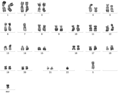 Figure 2 Cytogenetic analysis of bone marrow.