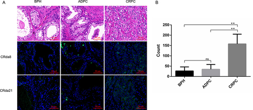 Figure 6 The clinical pathological human prostate tissues slides stained by FAM-labeled aptamers (n = 2×6 × 3×3). (A) Images in the first row showed HE staining of paraffin section from clinical pathological tissues of BPH, ADPC (Gleason score: 3+4) and CRPC (Gleason score: 5+5), respectively. Weak fluorescence signal was observed on BPH and ADPC tissues slides. Strong fluorescence signal was observed on CRPC tissues slides. (B) Quantitative analysis of specific immunofluorescence staining of CRPC tissues. HE staining represents hematoxylin and eosin staining; BPH represents benign prostatic hyperplasia; CRPC represents castration resistant prostate cancer; ADPC represents androgen dependent prostate cancer. Scale bars correspond to 50 μm in all images. Data represented as mean ± standard deviation. The experiments were repeated three times independently. **P < 0.01.