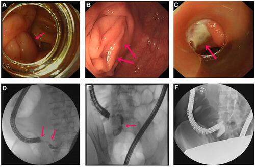Figure 1 The colonoscopic and radiological findings during ERA. (A and B) Hyperemic and bulging mucosa around the appendiceal orifice. (C) Pus discharge from the appendiceal orifice. (D) Intraluminal filling-defect sign. (E) Luminal distension and stenosis. (F) Normal appendix.