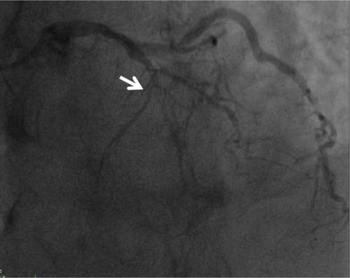 Figure 3 Coronary angiogram.Note: Selective left coronary injection shows mid-left anterior descending total occlusion without any collateral vessels (arrow).