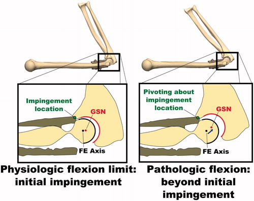 Figure 4. Illustration of non-physiologic subluxation of the ulnohumeral joint during flexion motions with simulated osteophytes attached. The deviation of the GSN from the FE axis is small at initial impingement when the physiologic flexion limit is met, but increases as the flexion angle is increased further. While this pathologic flexion motion occurs, the joint is hinging about the impingement point on the osteophyte, rather than the FE axis.