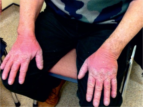 Figure 3 Photosensitive rash affecting light-exposed areas in a patient taking pirfenidone for 3 months during the winter in the North of England.
