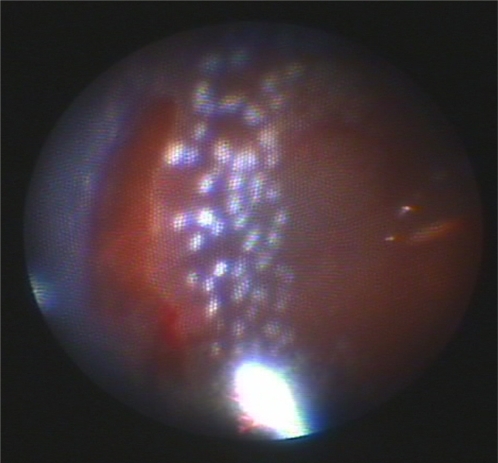 Figure 2 Intraoperative endoscopic view. Note clear view of necrotic retinal break treated with endophotocoagulation after removal of small foreign body in 5.30 o’clock position anterior to equator in peripheral retina.