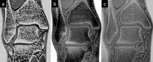 Figure 10 CT-like MRI of the ankle. Coronal reconstructions. (a) 3D T1w spoiled gradient-echo MR; (b) ultra-short echo time imaging; (c) zero echo time imaging.