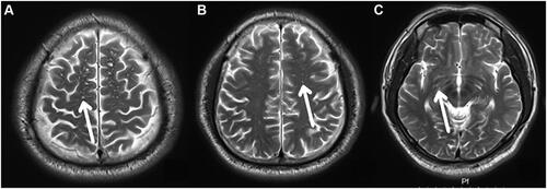 Figure 3 EPVS in OSA group observed at different layers. (A–C) display the frontoparietal subcortical white matter layer, centrum semiovale layer and basal ganglia layer; EPVS (white arrows).