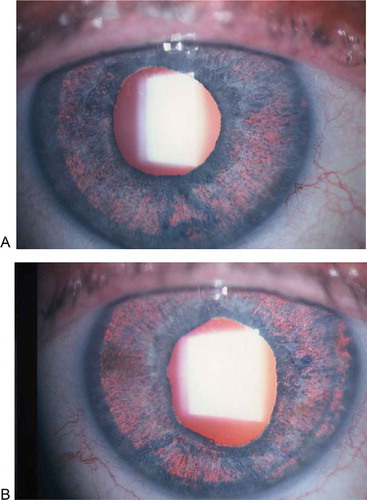 FIGURE 3. Diffuse iris transillumination and mild dilated distorted pupils in the right (A) and left (B) eye of a 56-year-old woman who had symptoms of bilateral acute iridocyclitis 1 month after the use of oral moxifloxacin for the treatment of urinary system infection