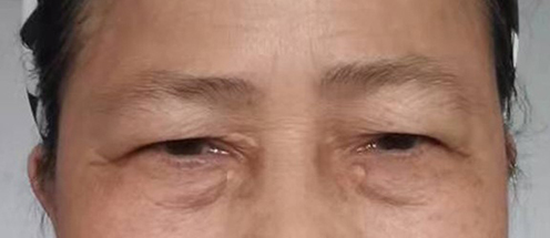 Figure 2 Clinical picture of the patient’s sister. Soft, yellow plaques were observed at the medial canthus of both the upper and lower eyelids.