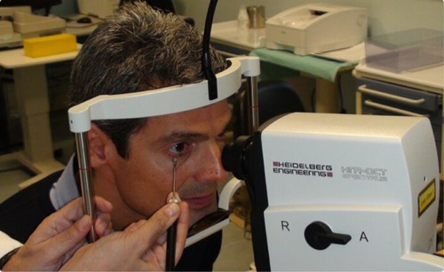 Figure 1 Application of the ophthalmodynamometer on the infratemporal eyelid during an SD-OCT examination.