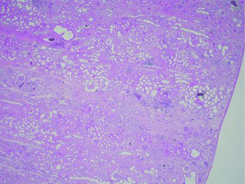 Figure 3. Histopathology of the kidney. Extensive interstitial fibrosis, scattered lymphocyte aggregates within the interstitium and renal tubule dilation.