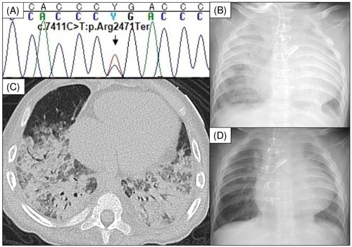 Figure 1. (A) The heterozygous KMT2D mutation c.7411C > T (p.Arg2471Ter) was identified in the proband. (B) Chest radiograph showing severe diffuse infiltration of bilateral lungs. (C) Chest computed tomography showing multiple ground glass opacities and consolidation in both lung fields. (D) Chest radiograph after methylprednisolone pulse therapy showing markedly decreased lung infiltration.
