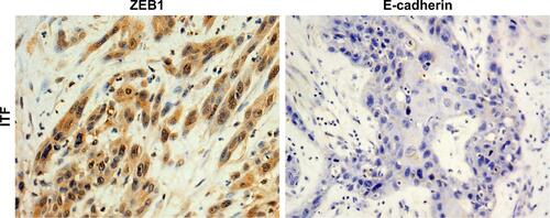 Figure S1 Representative images showing immunohistochemical staining for ZEB-1 and E-cadherin protein in the ITF of oral cavity squamous cell carcinoma (magnification ×200).Abbreviation: ITF, invasive tumor front.