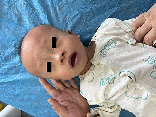 Figure 2 Craniofacial features of the child.