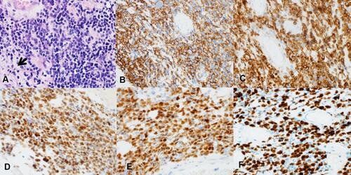 Figure 2 (A) Pathology examination by H&E staining revealing diffusely infiltrating large atypical lymphocytes dissecting through the nerve bundles (arrow indicating residual nerve). IHC studies showed that the neoplastic lymphocytes were positive for (B) CD20, (C) BCL2, (D) BCL6, (E) MUM1, (F) with a high proliferate rate (>90%) by Ki-67.