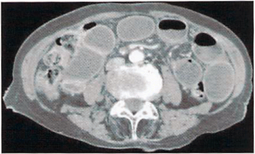 Figure A.6. Abdominal contrast-enhanced computed tomography (case 5, mid-abdomen level).