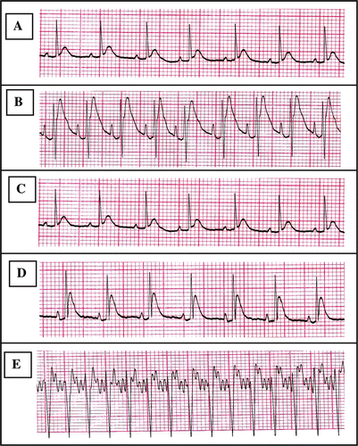 Figure 1.  Chart records showing ECG tracings; A: ECG for control group, B: ECG for Dox-treated group, C: ECG for (Pro)-treated group, D: ECG for (Dox + Pro)-treated group, and E: Electrocardiographic tracing of a control anesthetized rat infused with aconitine. Anesthesia was induced by urethane (1.8 g/kg, i.p.). Aconitine (2.5 µg/ml) was infused via jugular vein in a rate of (0.5 ml/min) till appearance of ventricular tachycardia (VT). Electrocardiograms were recorded from standard lead II limb leads. The sensitivity was 2 mV and chart speed was 50 mm/sec.