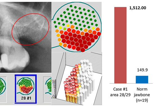 Figure 7 Left window: OPG of area 28/29 with overview of TAU measurement under radiograph. Middle window: Enlarged single image of the TAU measurement at 26, above in two-dimensional and below in three-dimensional imaging, showing hard root portions of tooth 26 in green with surrounding reduced bone density in red, as a sign of osteodestruction. Right window: Result of the multiplex measurement of the alveolar BMDJ/FDOJ sample with an R/C expression of 1512 pg/mL (red column) compared to the R/C expression of 149.9 pg/mL in healthy jawbone (blue column). Figure Indicators: Red circles mark inflammatory areas of alveolar bone.
